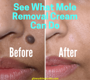 A woman with a dark mole on her face before applying mole remover cream and the same lady with the mole having been cleared and the face smooth after applying the best mole removal cream