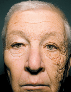 Bill McElligott, a truck driver, photographed in 2012 to show how the left side of his face had aged much faster than the right side due to direct sun exposure to the left side