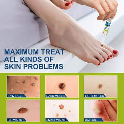 TopNaturePlus Milia Remover has been proven to treat skin tags, warts, dark and light moles, milia, corns, and calluses on the feet