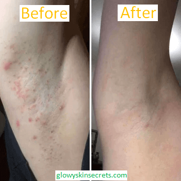Wondering how to get rid of underarm bumps and darkness? Here are successful results on our webpage.